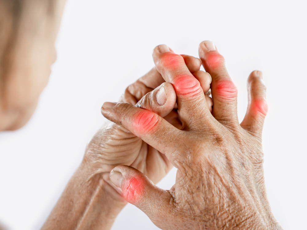 Người bị gout