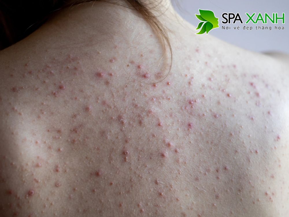 1. Nguyên nhân gây mụn ở lưngn da mịn màng, khỏe mạnh.