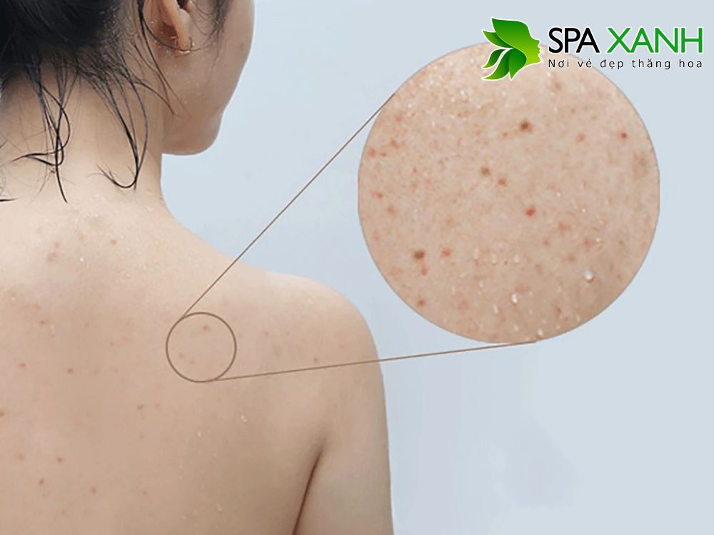 2. Dấu hiệu nhận biết mụn ở lưng