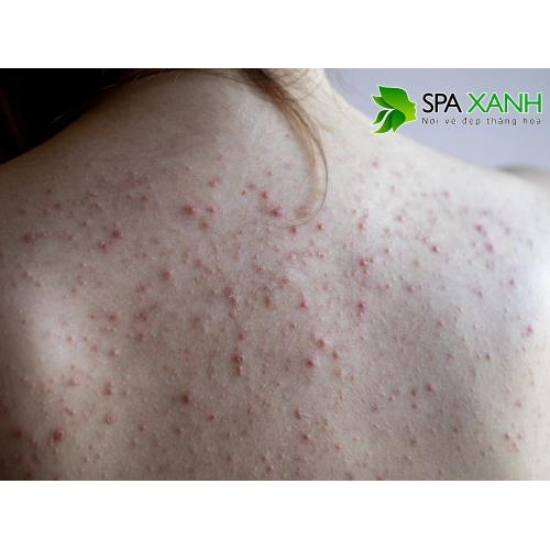 1. Nguyên nhân gây mụn ở lưngn da mịn màng, khỏe mạnh.