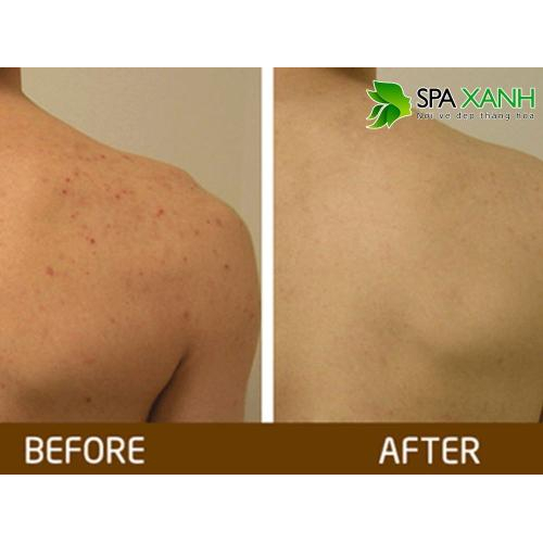 5. Cam kết hiệu quả từ SpaXanh.vn & lưu ý sau điều trị