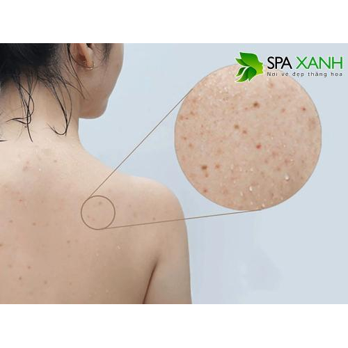 3. Cách cải thiện và ngăn ngừa mụn ở lưng tại nhà