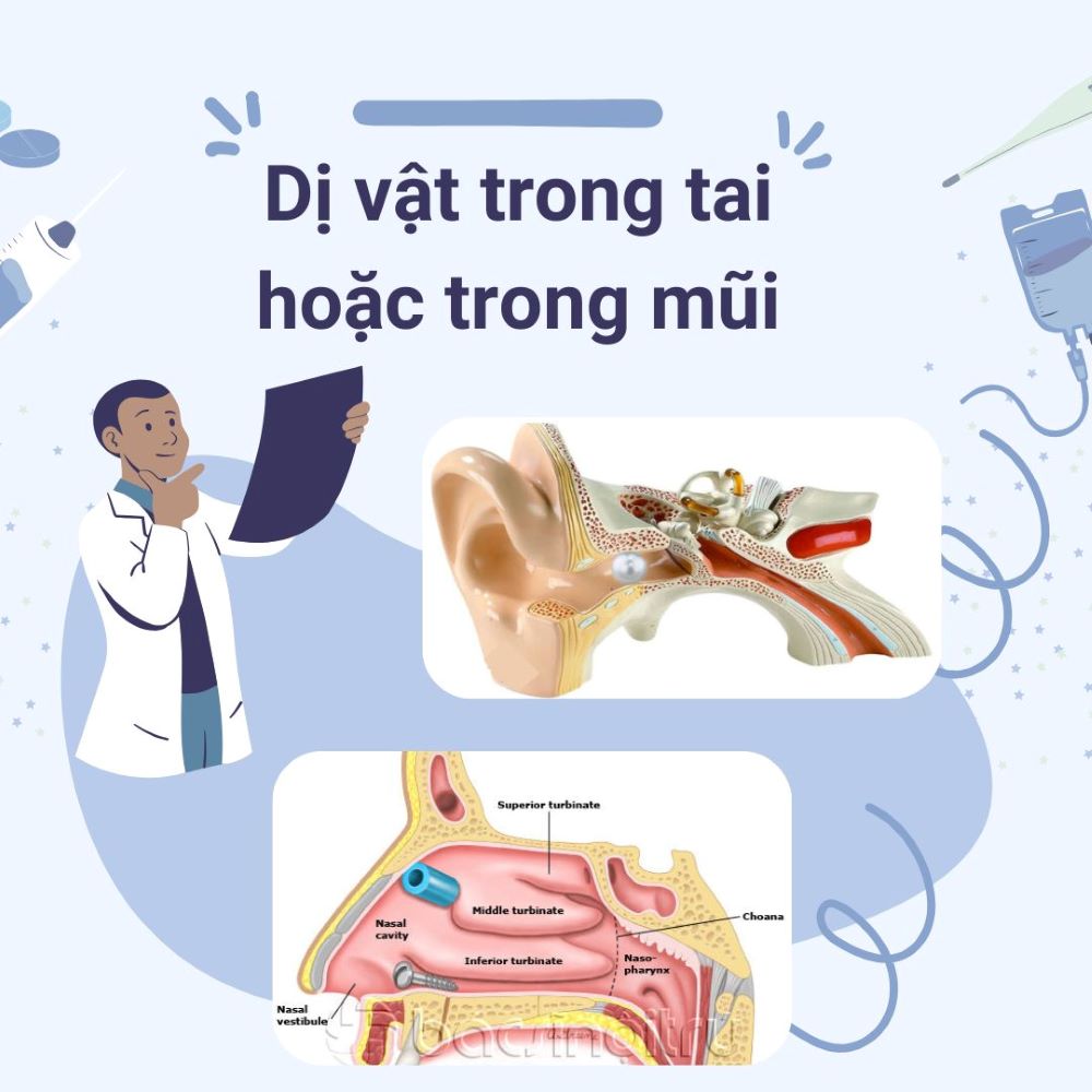 Dị Vật Trong Tai Hoặc Trong Mũi