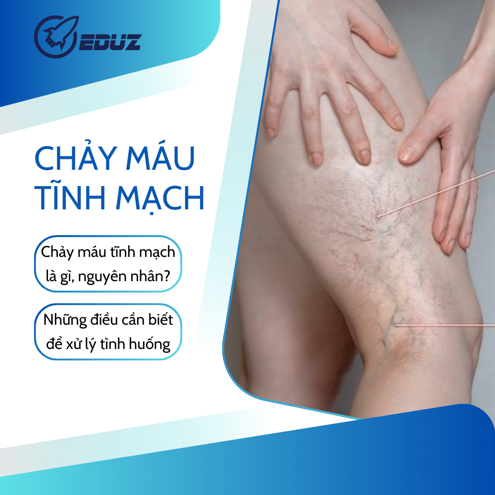 Chảy Máu Từ Tĩnh Mạch Đã Suy