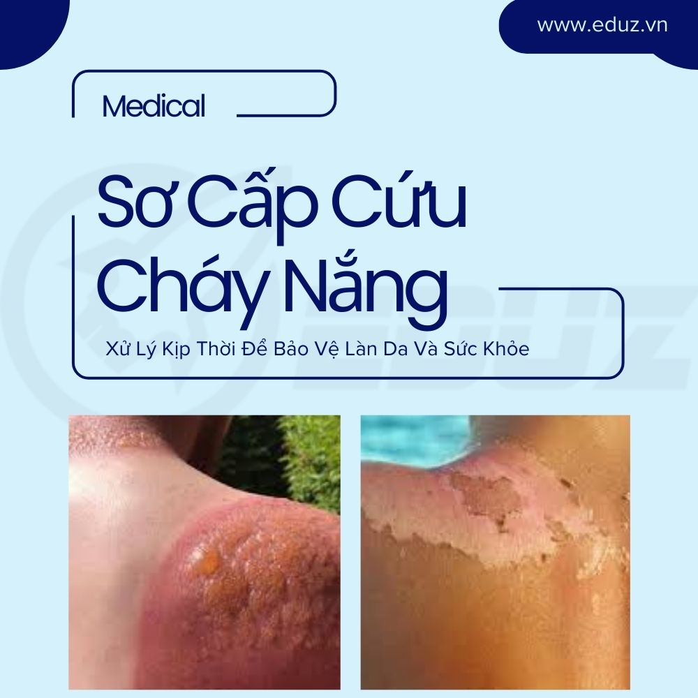 Xoa Dịu Làn Da Cháy Nắng: Hướng Dẫn Sơ Cứu Cháy Nắng Nhanh Chóng và Hiệu Quả