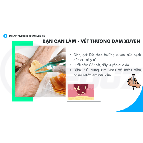 3.	Vết Thương Đâm Xuyên: