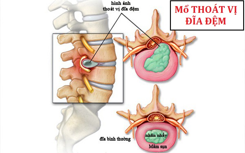 Thoát Vị Đĩa Điệm Có Mổ Không?