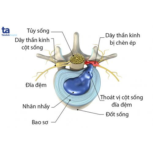 Yếu Sinh Lý Có Phải Do Thoát Vị Đĩa Đệm